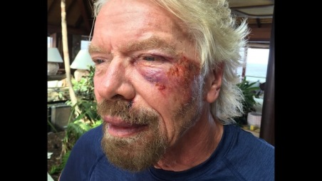 Undated handout image issued by Virgin.com on Friday Aug. 26, 2016, of Sir Richard Branson after he was involved in an accident when he crashed his bicycle on Virgin Gorda, one of the British Virgin Islands in the Caribbean. The Virgin founder badly damaged his cheek and suffered severe cuts to his knee, chin, shoulder and body. Sir Richard said: "I was heading down a hill towards Leverick Bay when it suddenly got really dark and I managed to hit a traffic hump in the road head on.(Virgin.com via AP)